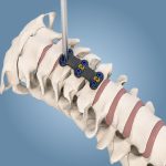 Placa Cervical Anterior02